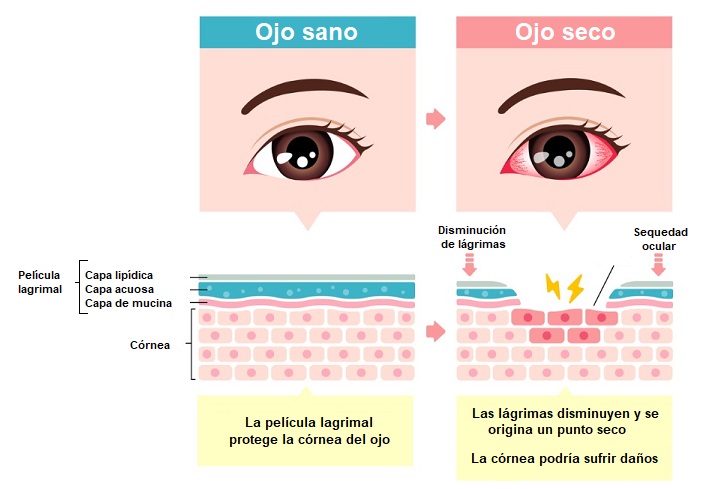 Ilustración de síntomas de ojo seco